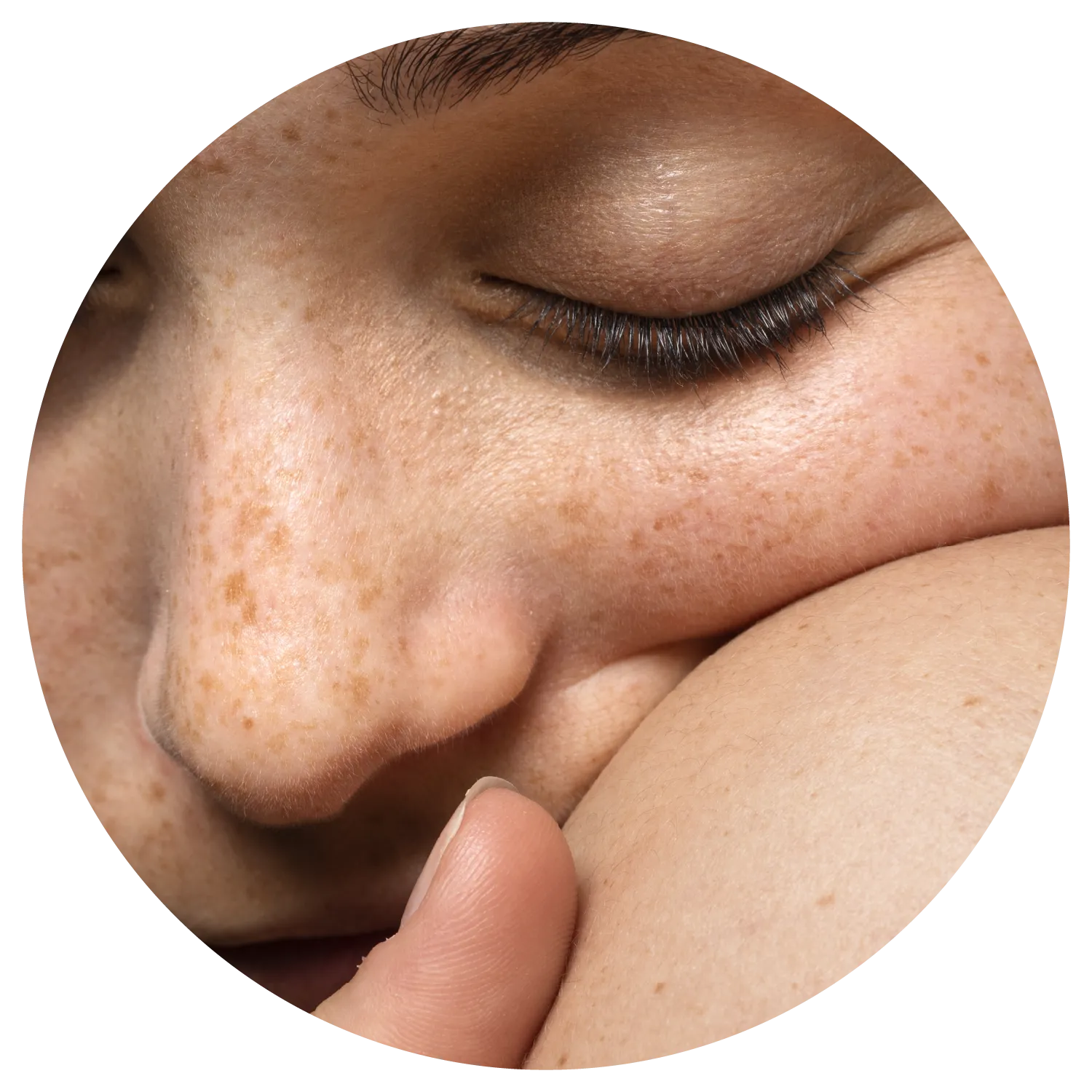 Age Spots treatment process at Toronto medical spa - Why pigmentation is more than skin deep.